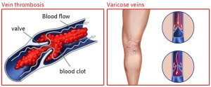 Venous congestion | REGENAPLEX